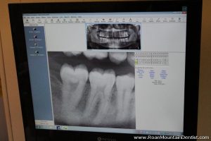 Digital Dental X-rays